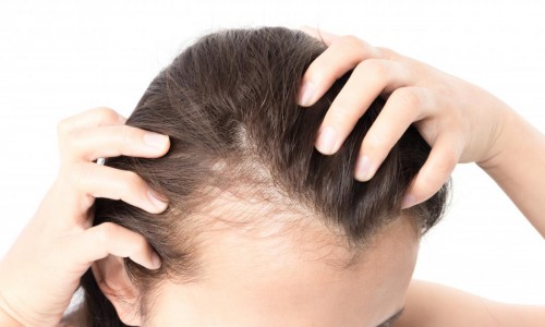 چگونه ریزش مو در زنان را درمان کنیم؟