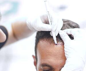 بررسی حقایق پیرامون پیوند مو