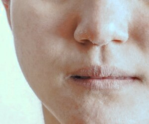 بررسی علل خشکی لبها و راهکارهای مؤثر برای درمان آن