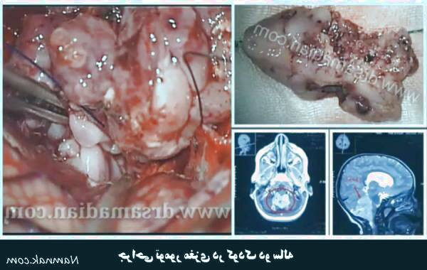 بررسی انواع تومورهای مغزی