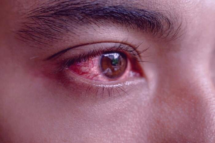 خراشیدگی چشم به چه دلیلی پدید می آید؟ حساسیت چشم به نور و تاری بینایی