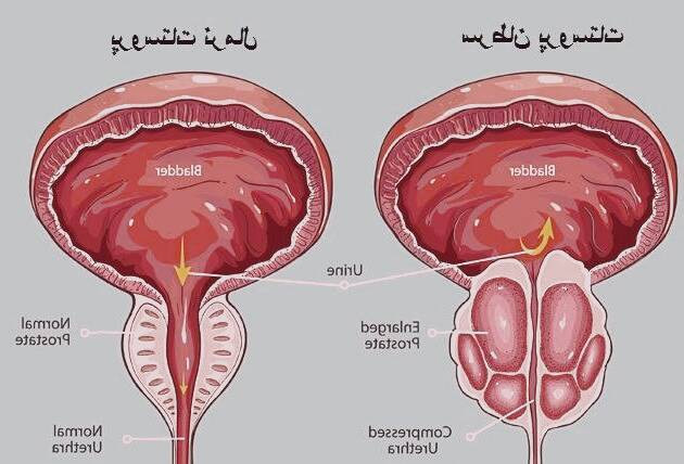 سرطان پروستات