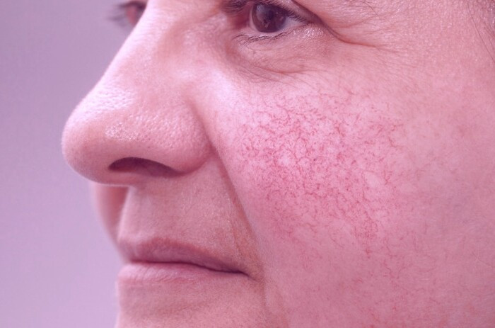 رگ های عنکبوتی