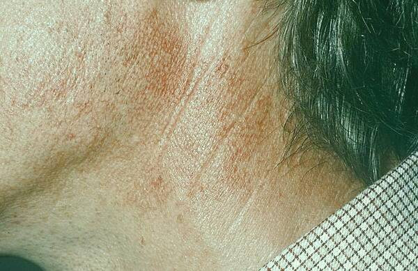 بیماری acanthosis nigricans acanthosis nigricans