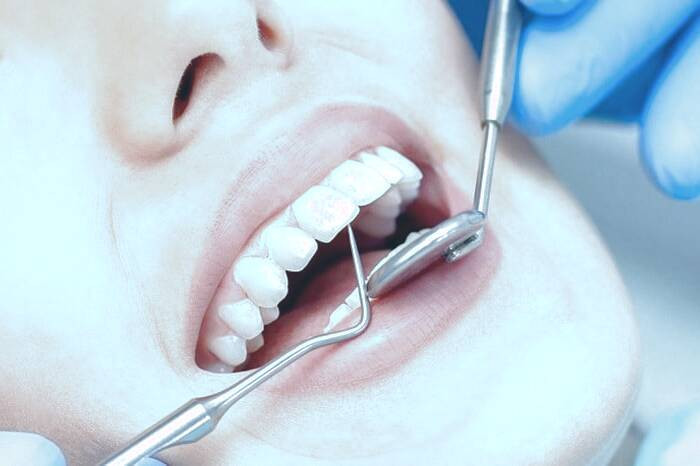 عصب کشی دندان چیست و چگونه یک عصب کشی انجام میشود ؟ عصب کشی دندان