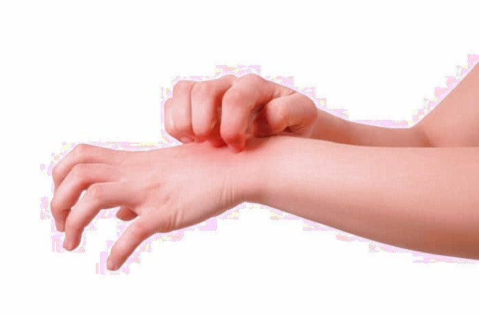 آلرژی
