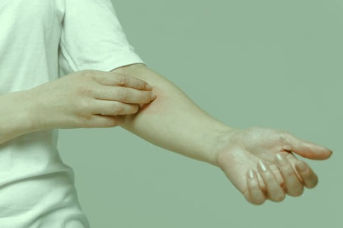 علائم اگزما خارش پوست