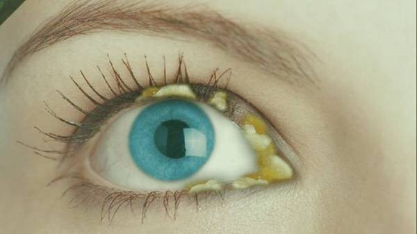 رنگ ترشح چشم 