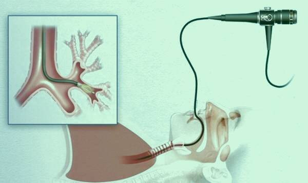 تصویربرداری در برونکوسکوپی