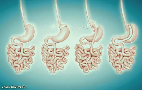 عوارض عمل بای پس معده 