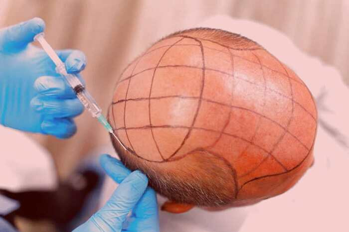 نحوه کاشت مو