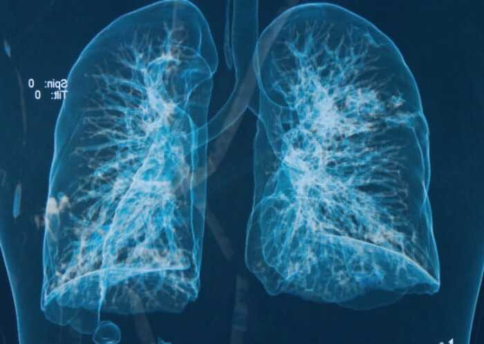 درمان ذات الریه