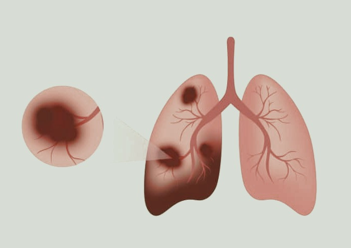 علت ذات الریه