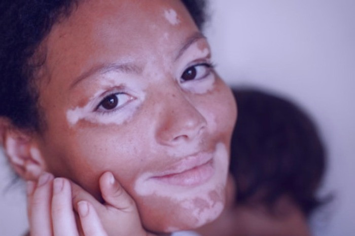 لکه های پوستی مادرزادی