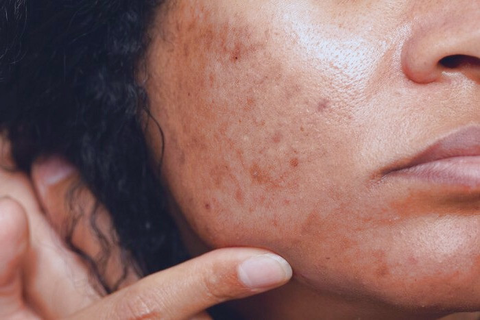 لکه های تیره 