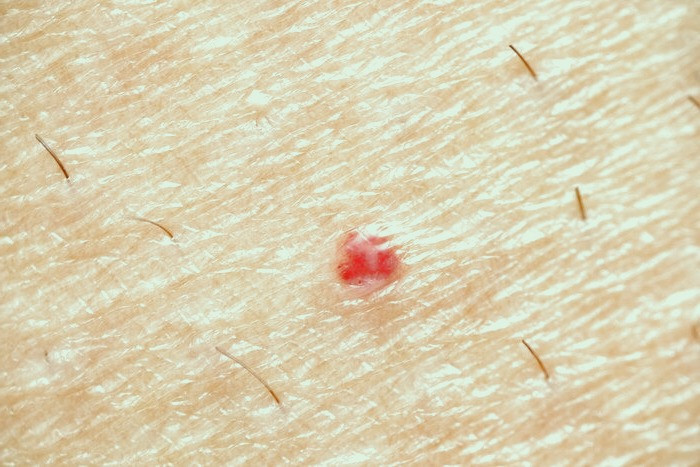 لکه های پوستی قرمز