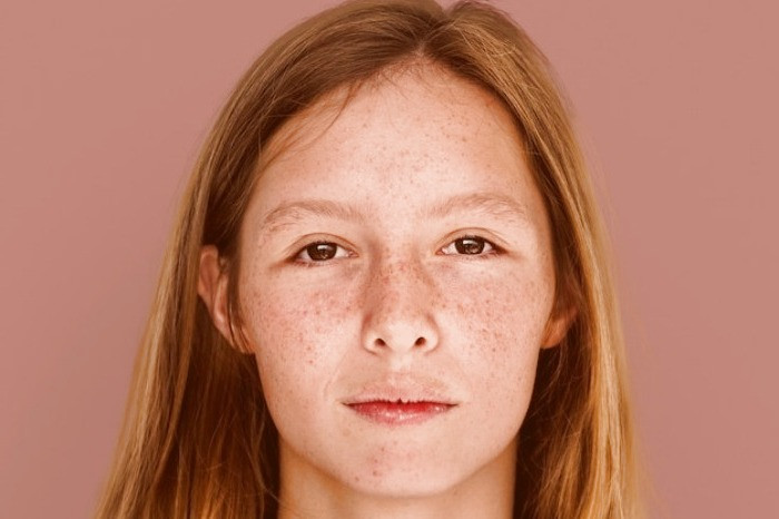 لکه های حاملگی