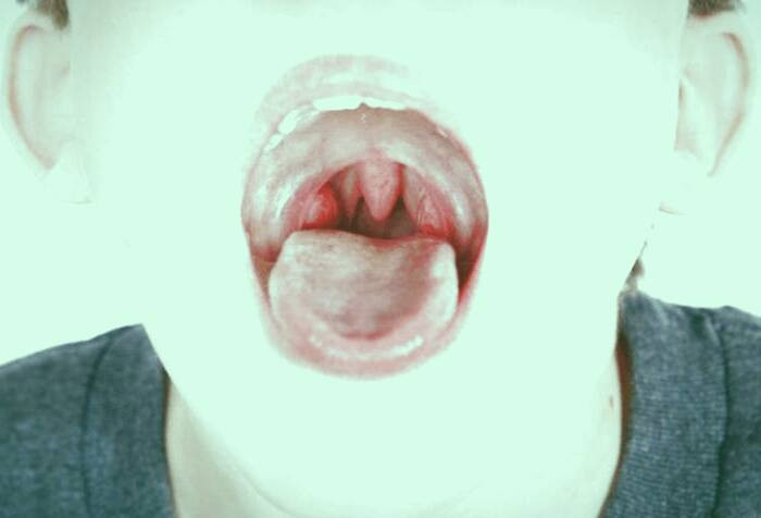 بیماری لوزه