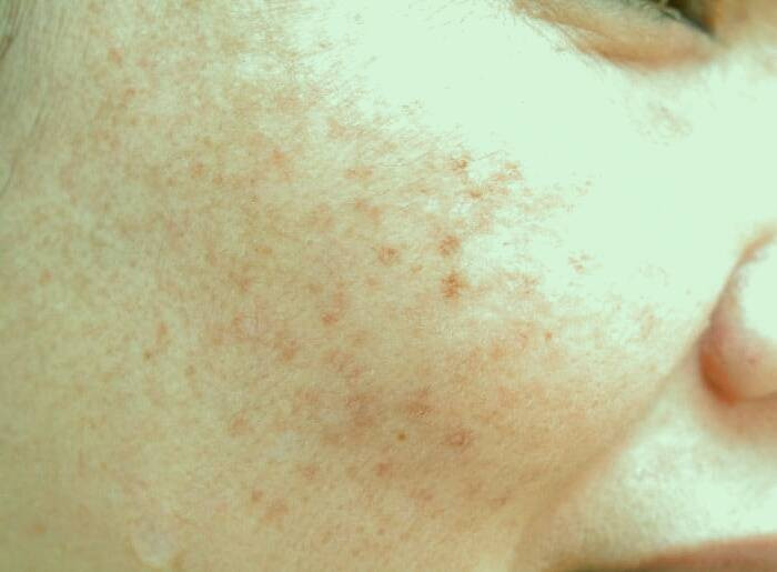 هایپرپیگمنتیشن