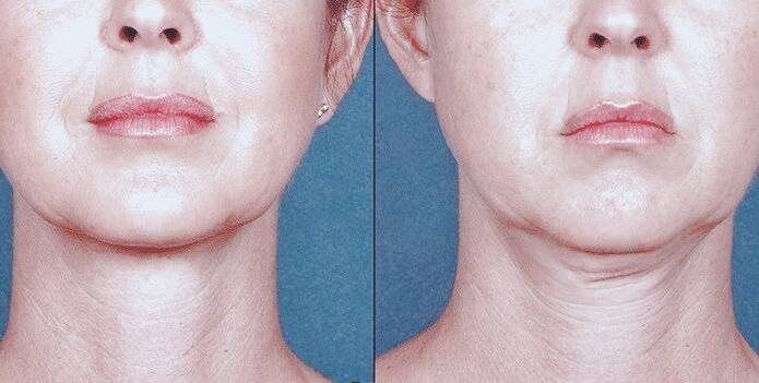 از بین بردن غبغب