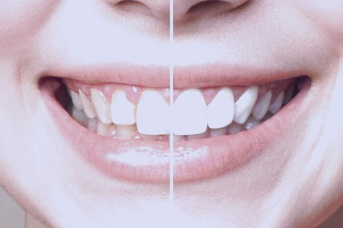 جرم گیری دندان