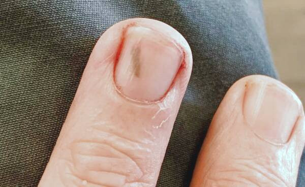 تراشه های زیرناخنی