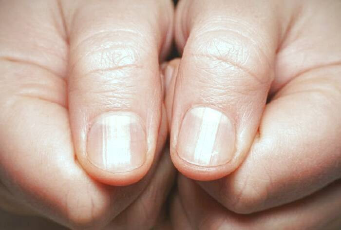 قرمزی ناخن از علائم دیابت قرمزی ناخن