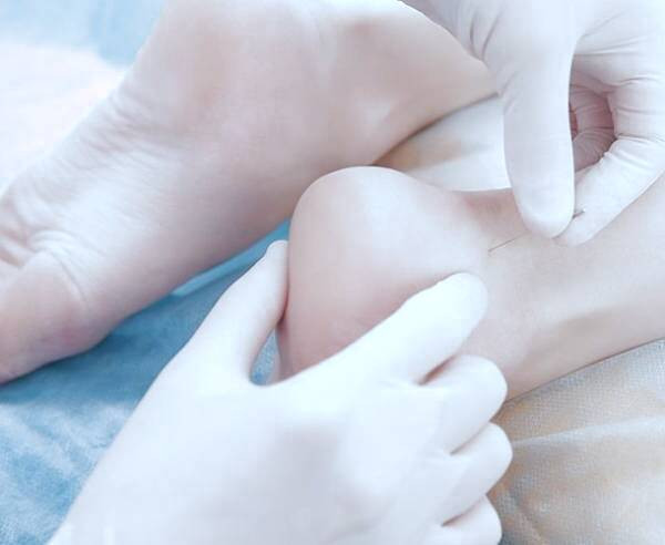 طب سوزنی پاشنه پا طب سوزنی