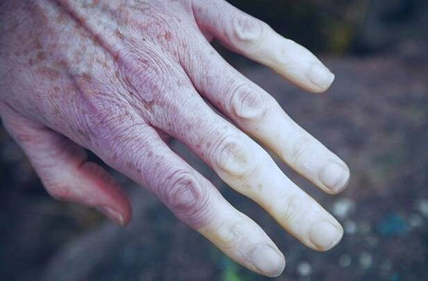 لوپوس از دلایل بی حسی و خواب رفتگی دست ها لوپوس