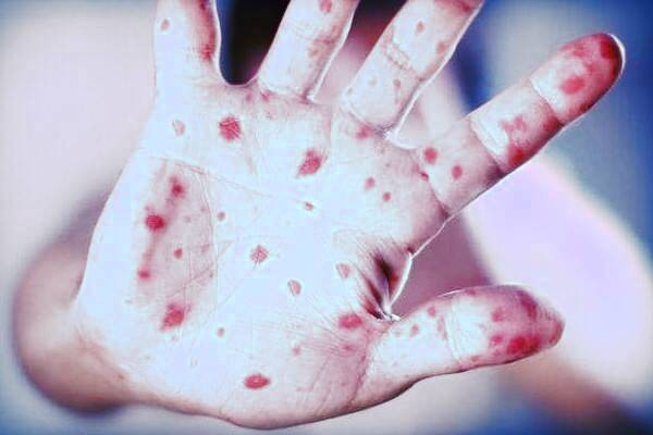 نشانه های بیماری سرخجه سرخجه چیست