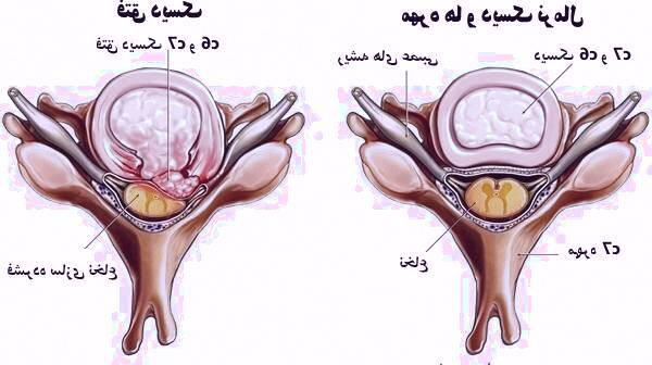 علل فتق دیسک بین مهره ای