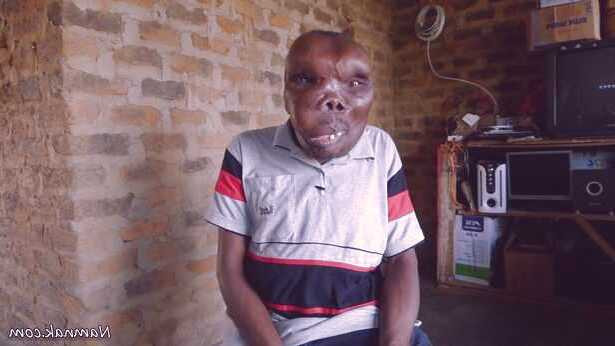 سندرم سنگ کننده