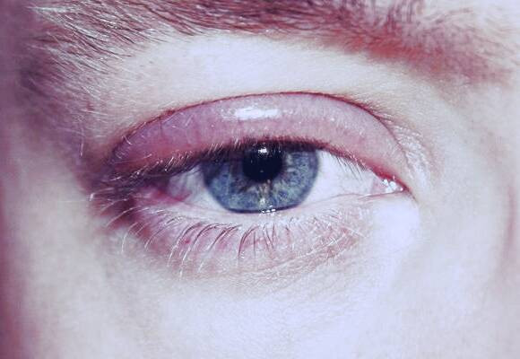 بلفاریت چیست