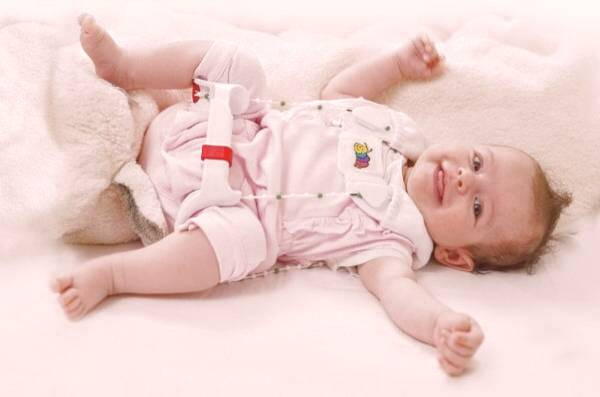 علائم در رفتگی مادرزادی لگن