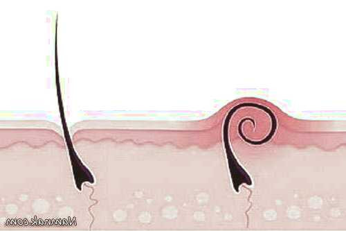 موهای زیرپوستی 