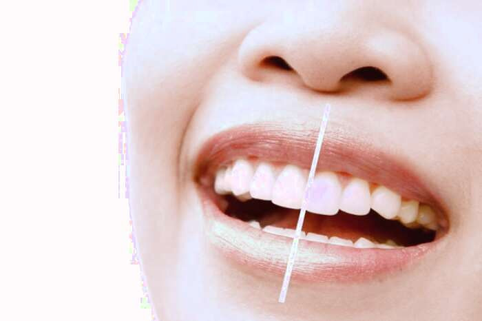 سفید شدن دندان