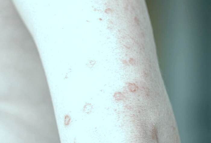 مشکلات پوستی