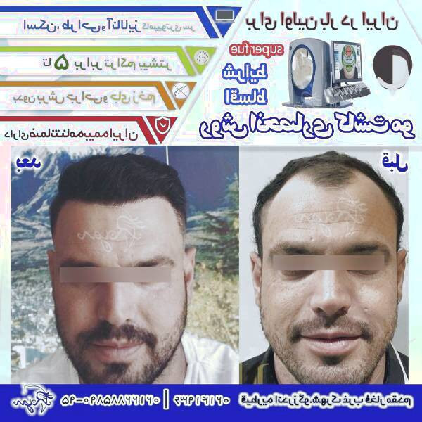 کاشت ریش و سبیل