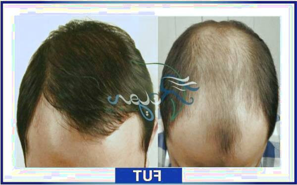 بررسی جامع کاشت مو