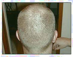 کاشت و مو در کلینیک معتبر با تصاویر