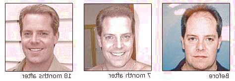 کاشت و مو در کلینیک معتبر با تصاویر