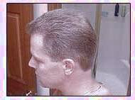 کاشت و مو در کلینیک معتبر با تصاویر