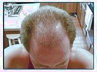 کاشت و مو در کلینیک معتبر با تصاویر