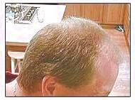 کاشت و مو در کلینیک معتبر با تصاویر