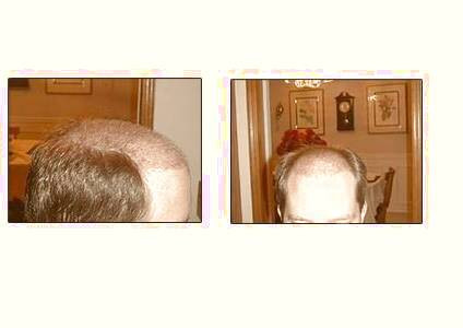 کاشت و مو در کلینیک معتبر با تصاویر