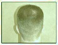 کاشت و مو در کلینیک معتبر با تصاویر