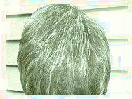 کاشت و مو در کلینیک معتبر با تصاویر