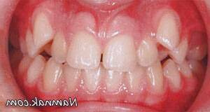 انواع ناهنجاری های شایع دندان ناهنجاری دندان