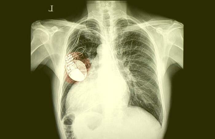 انجام اکو برای قلب اکوی قلب