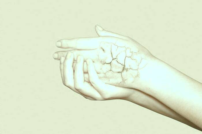 خشکی پوست با آب گرم بیماری پوستی